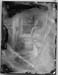 collodion015